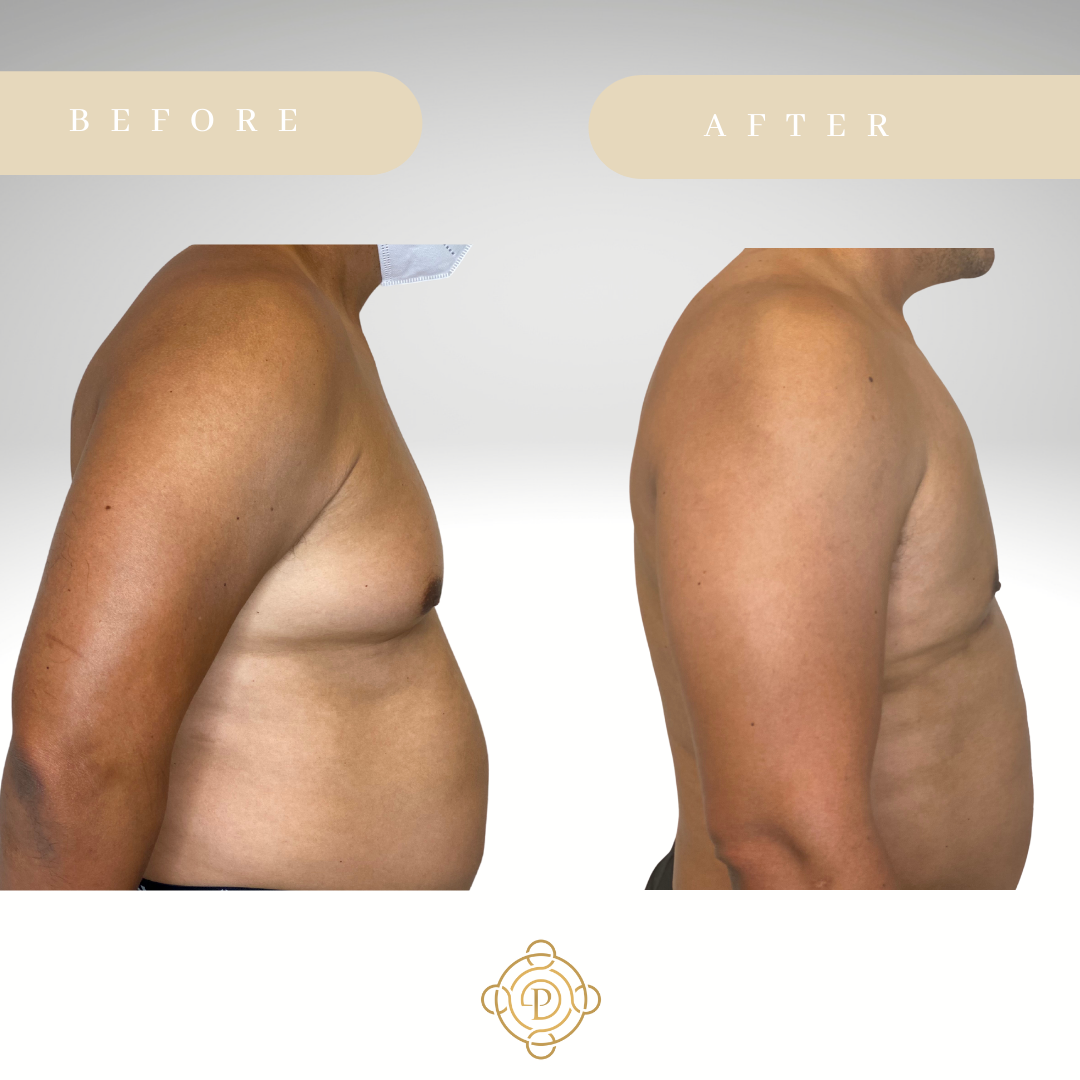 Side view of a male patient before and after gynecomastia treatment.