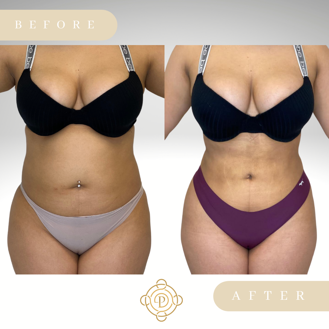 Female patient before and after liposuction and Brazilian Butt Lift..