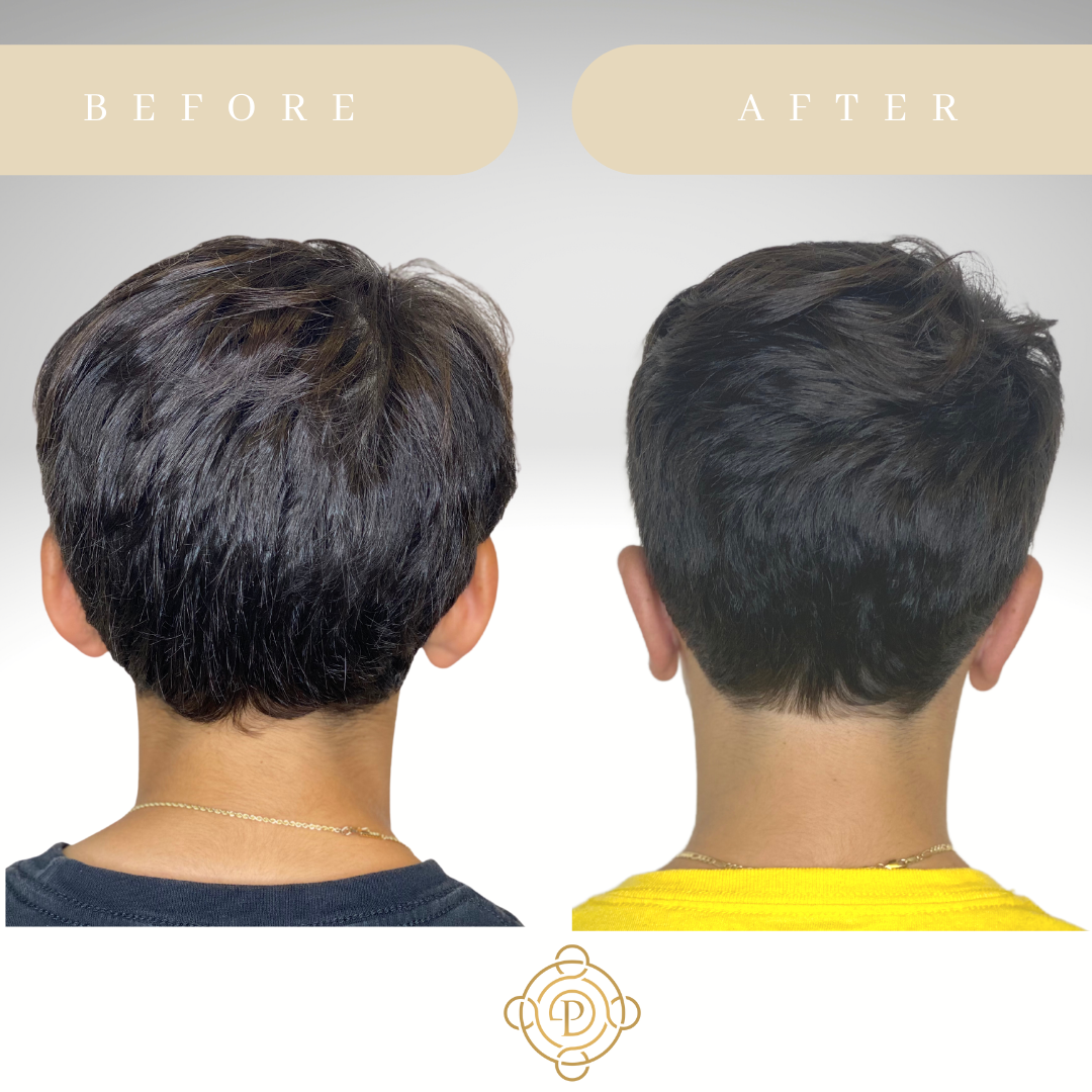 Back view of a teenage boy before and after otoplasty.