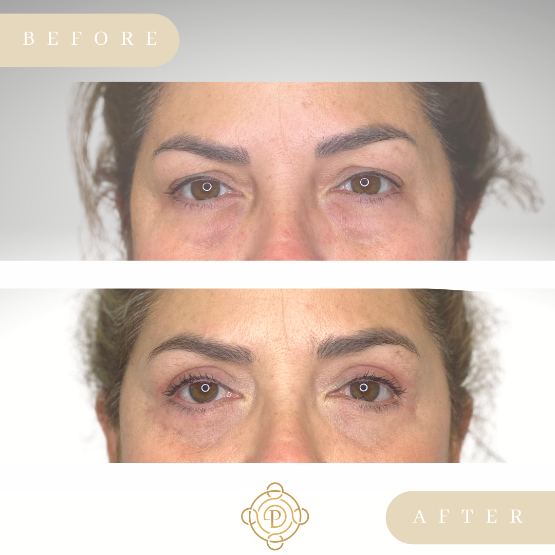 Female patient before and after blepharoplasty.