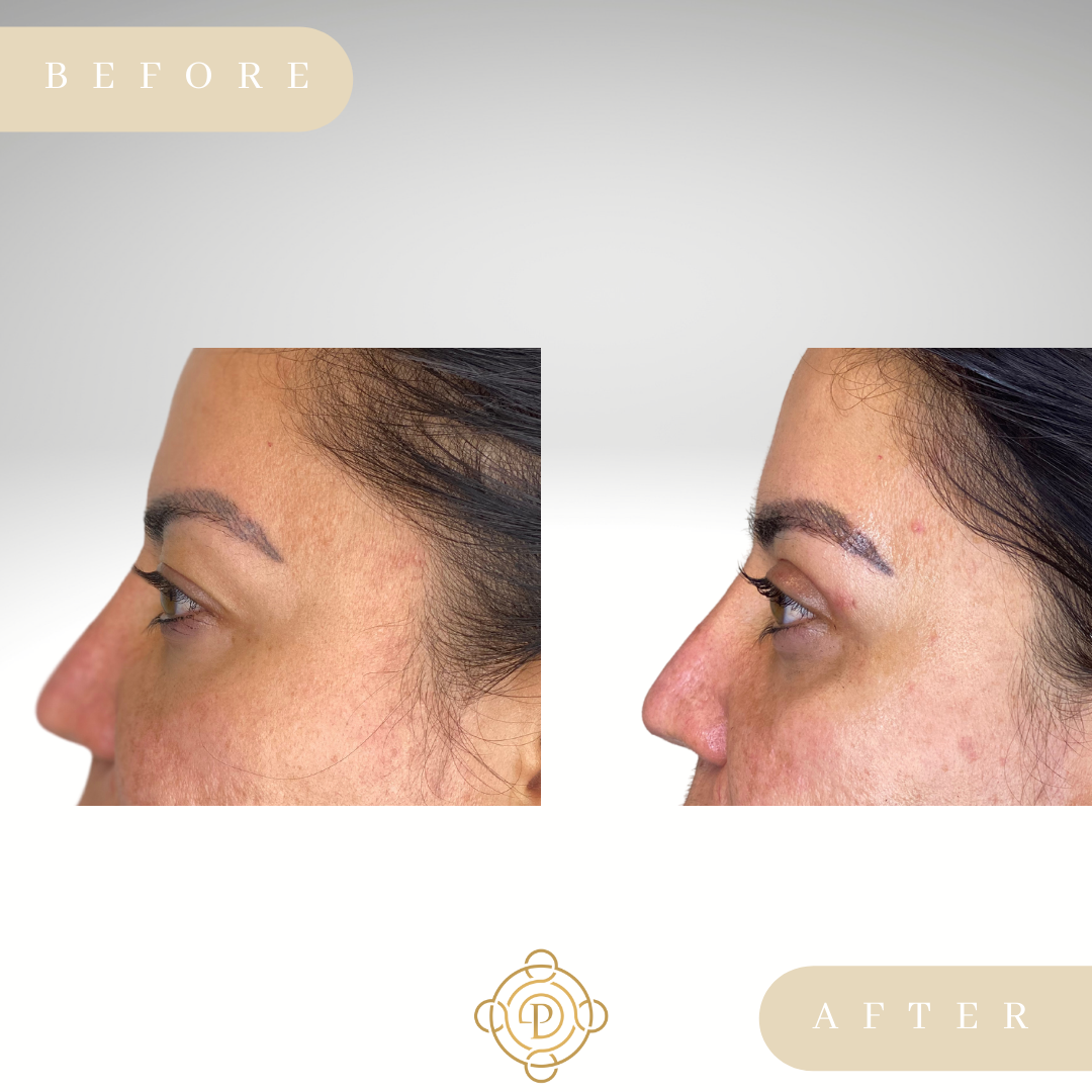 Side view of a female patient before and after blepharoplasty.