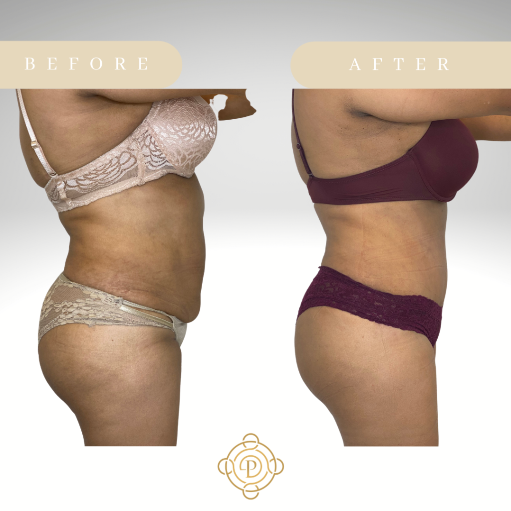 Side view of a female patient before and after tummy tuck.