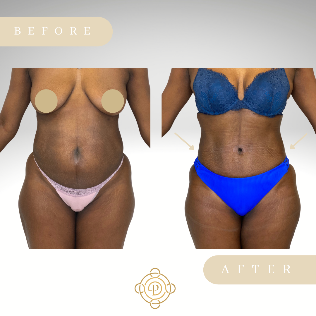 Female patient before and after tummy tuck.
