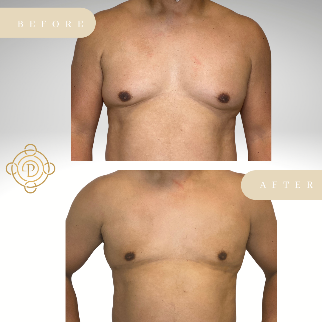 Male patient before and after gynecomastia treatment.
