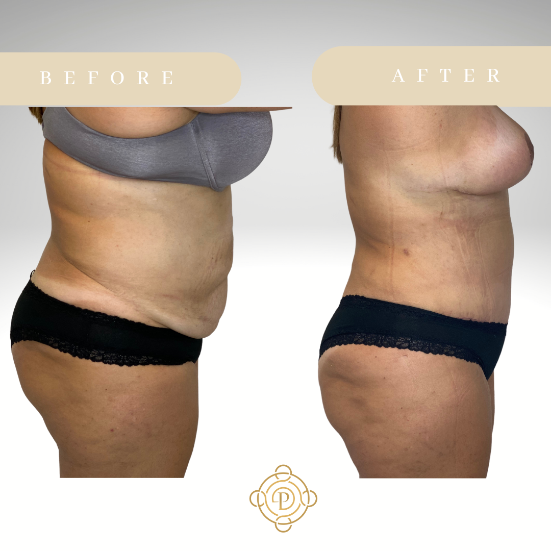 Side view of a female patient before and after tummy tuck.