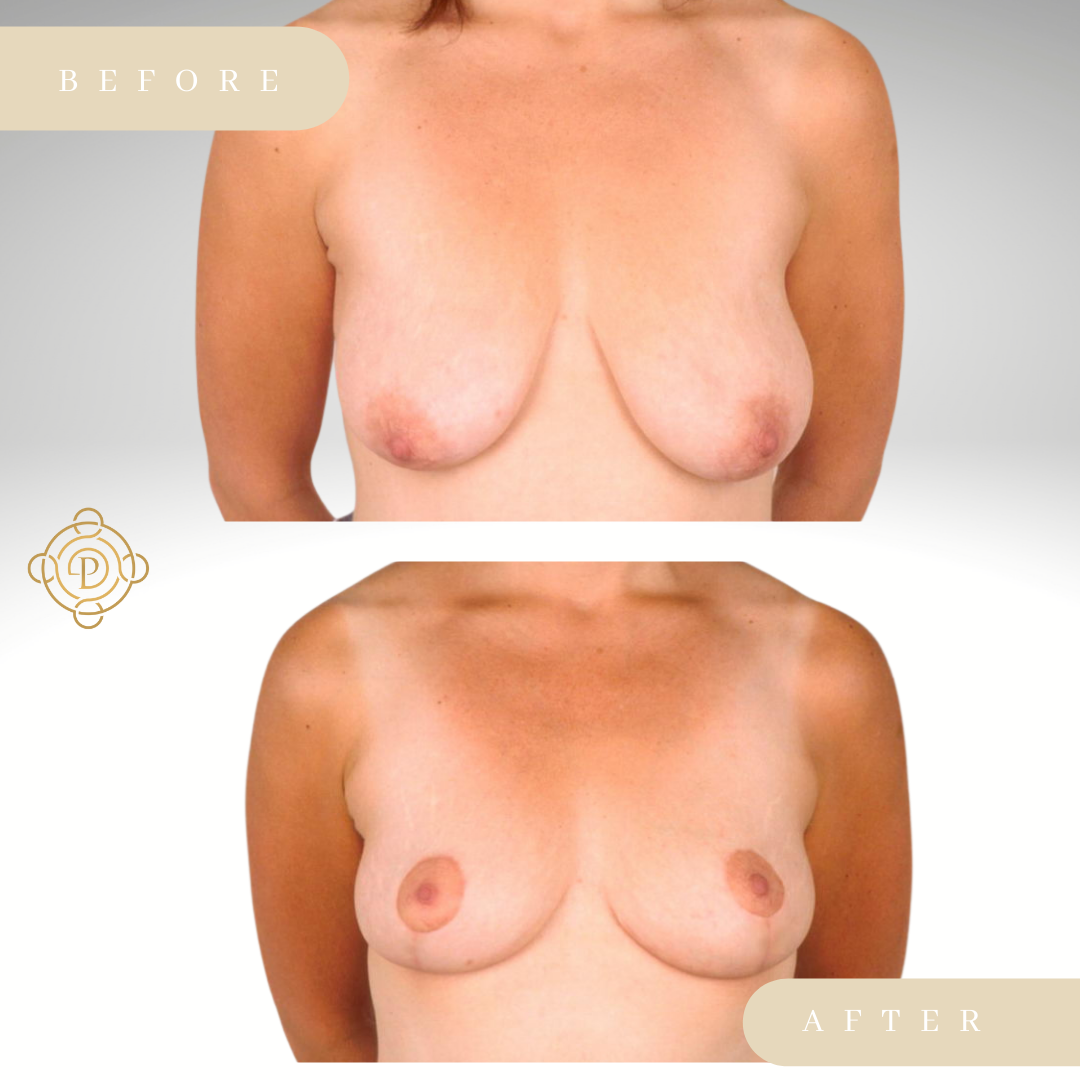 Female patient before and after breast lift.