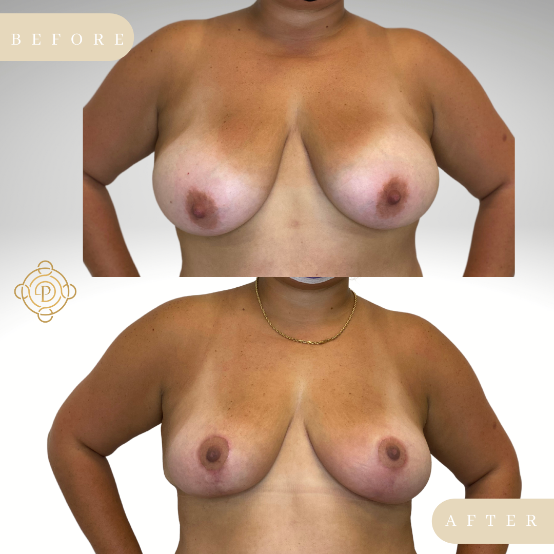 Female patient before and after breast lift.
