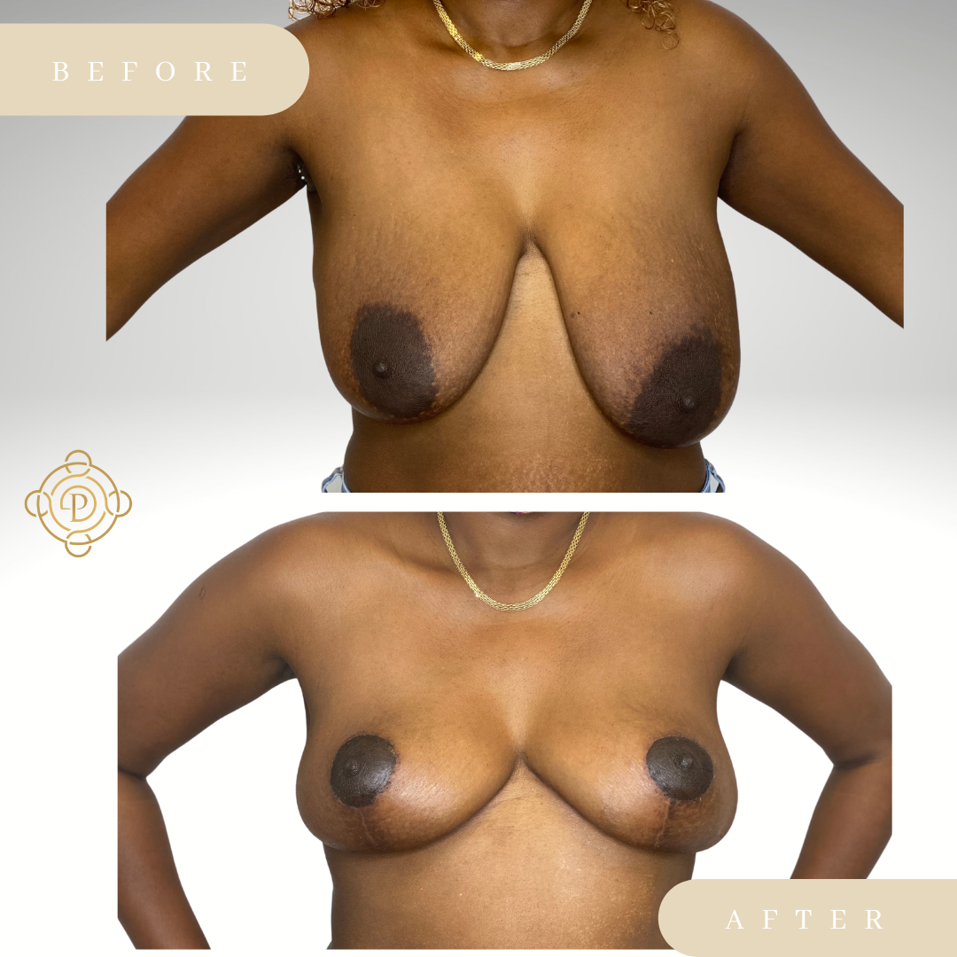 Female patient before and after breast reduction procedure.