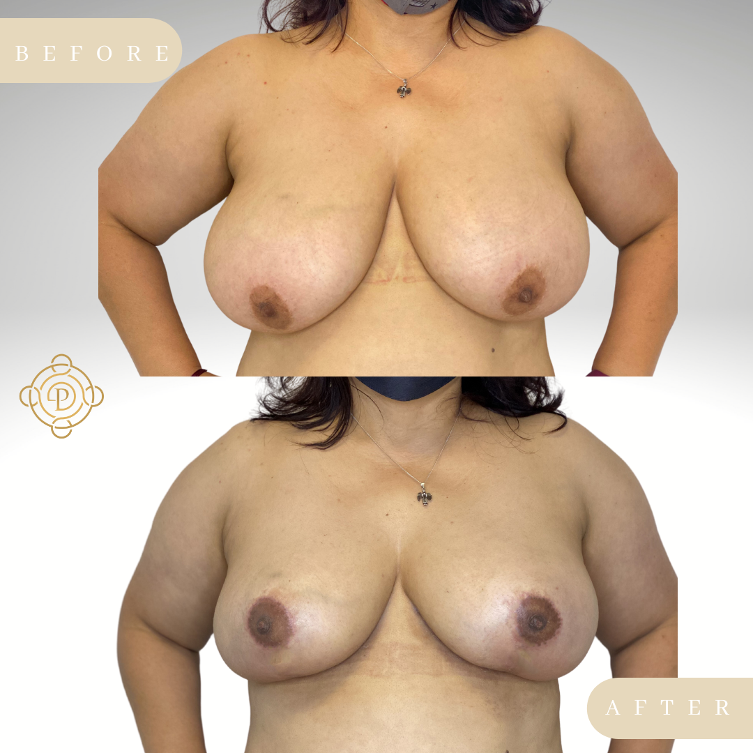 Female patient before and after breast reduction procedure.