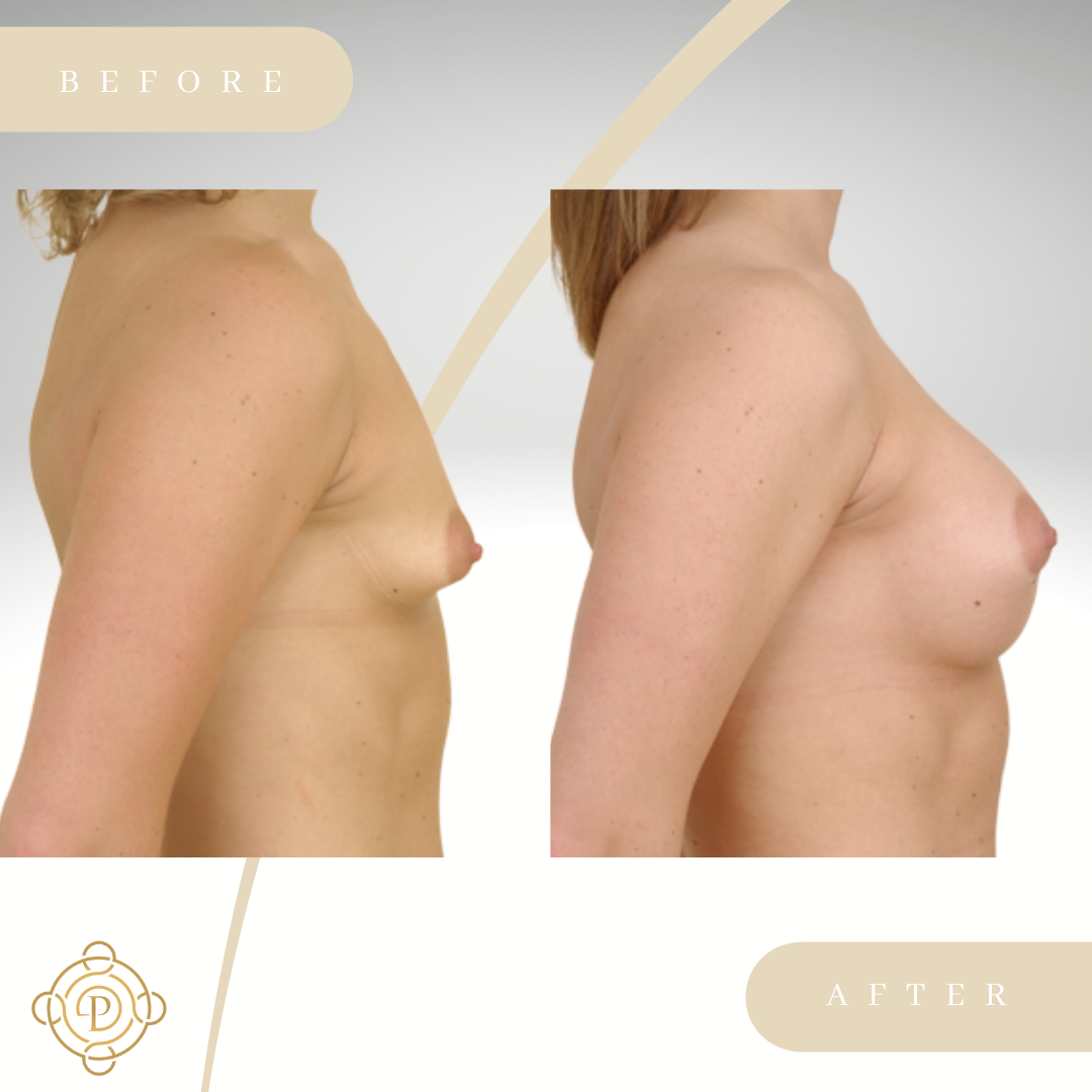 Side view of a female patient before and after tuberous breast correction surgery.
