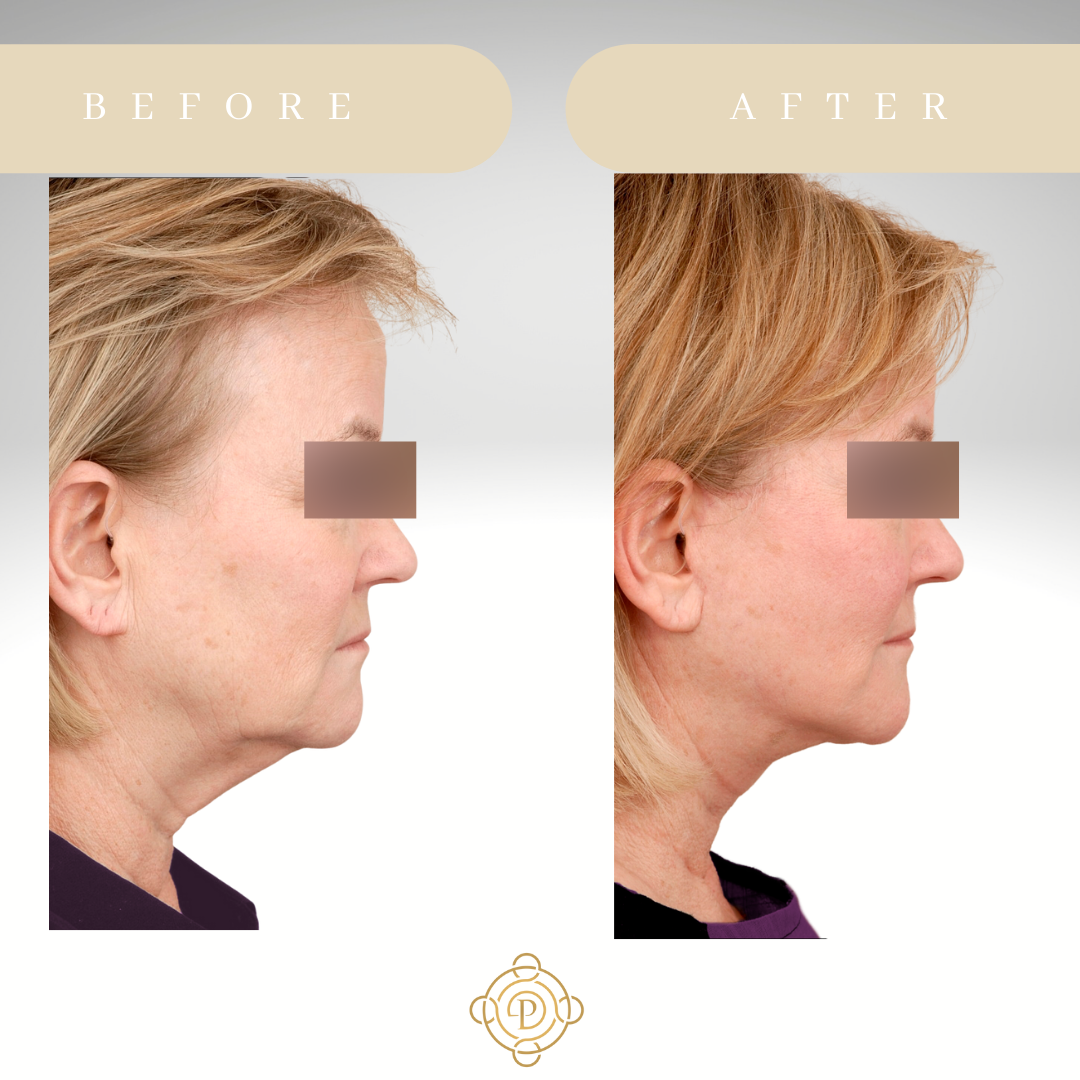 Side view of a female patient before and after facelift.