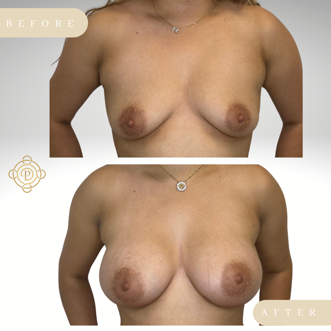 Female patient before and after breast augmentation procedure.