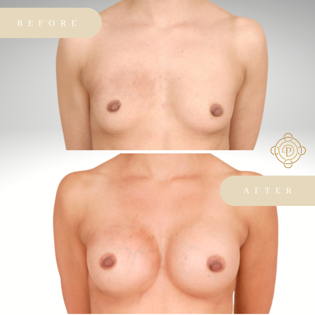 Female patient before and after breast augmentation procedure.