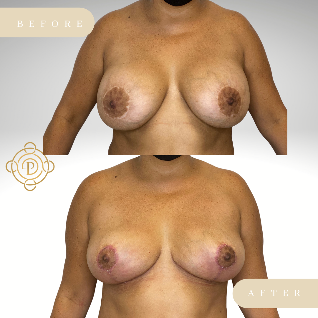 Female patient before and after breast implant removal procedure.