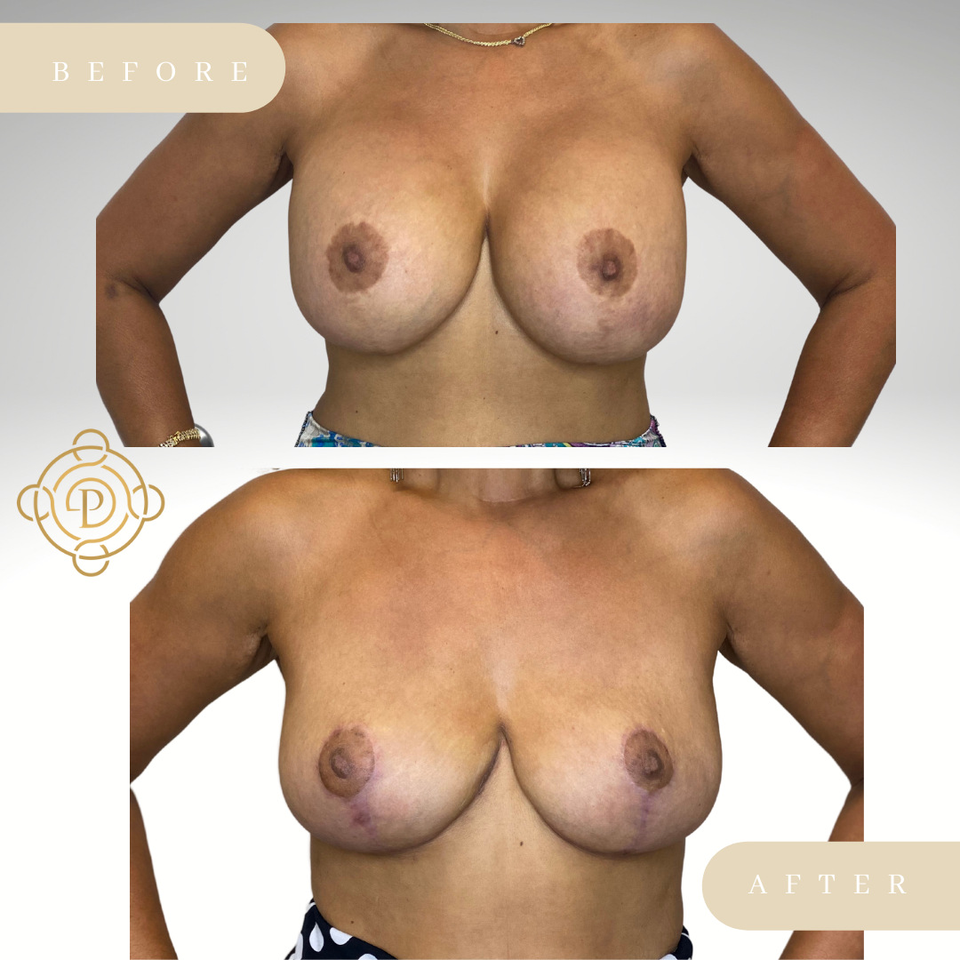 Female patient before and after breast implant removal procedure.