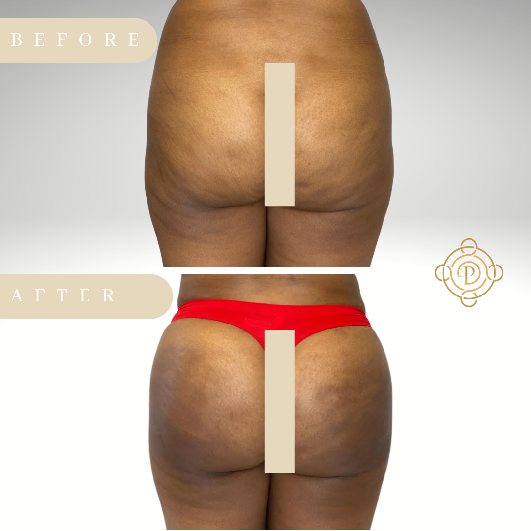 Back view of a female patient before and after liposuction and Brazilian Butt Lift..