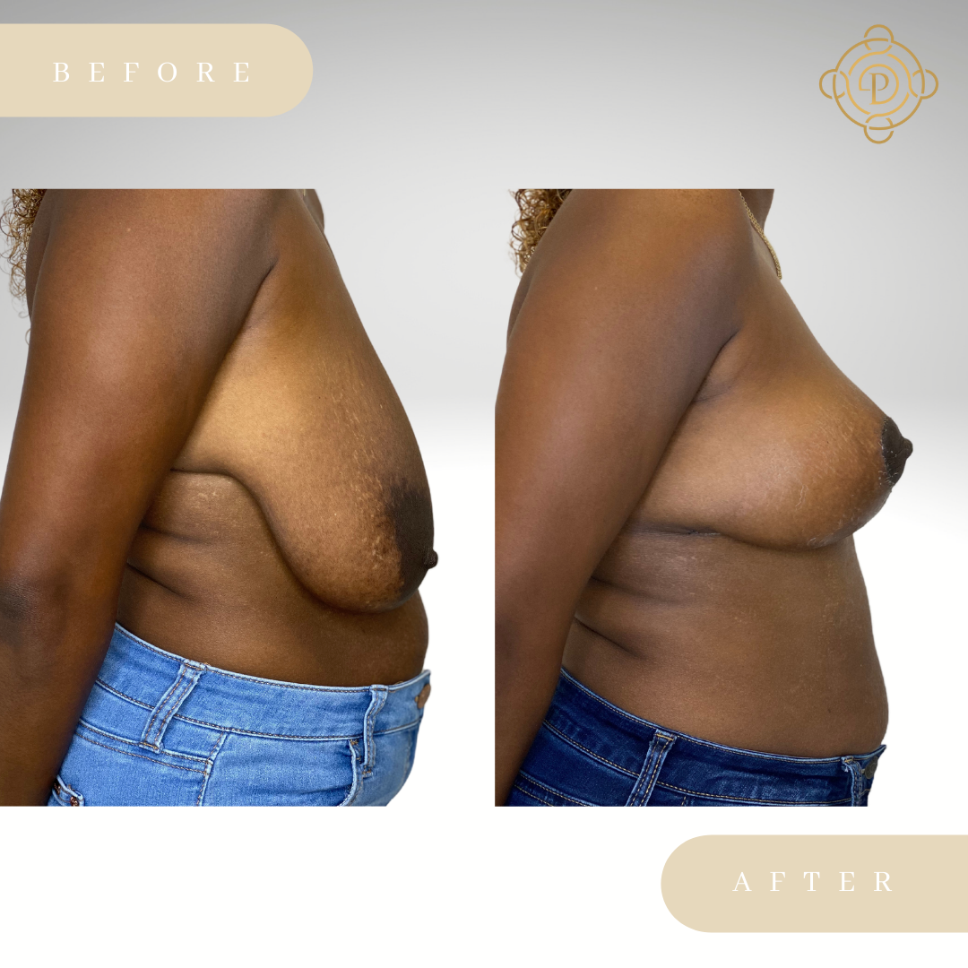 Side view of a female patient before and after breast asymmetry correction procedure.