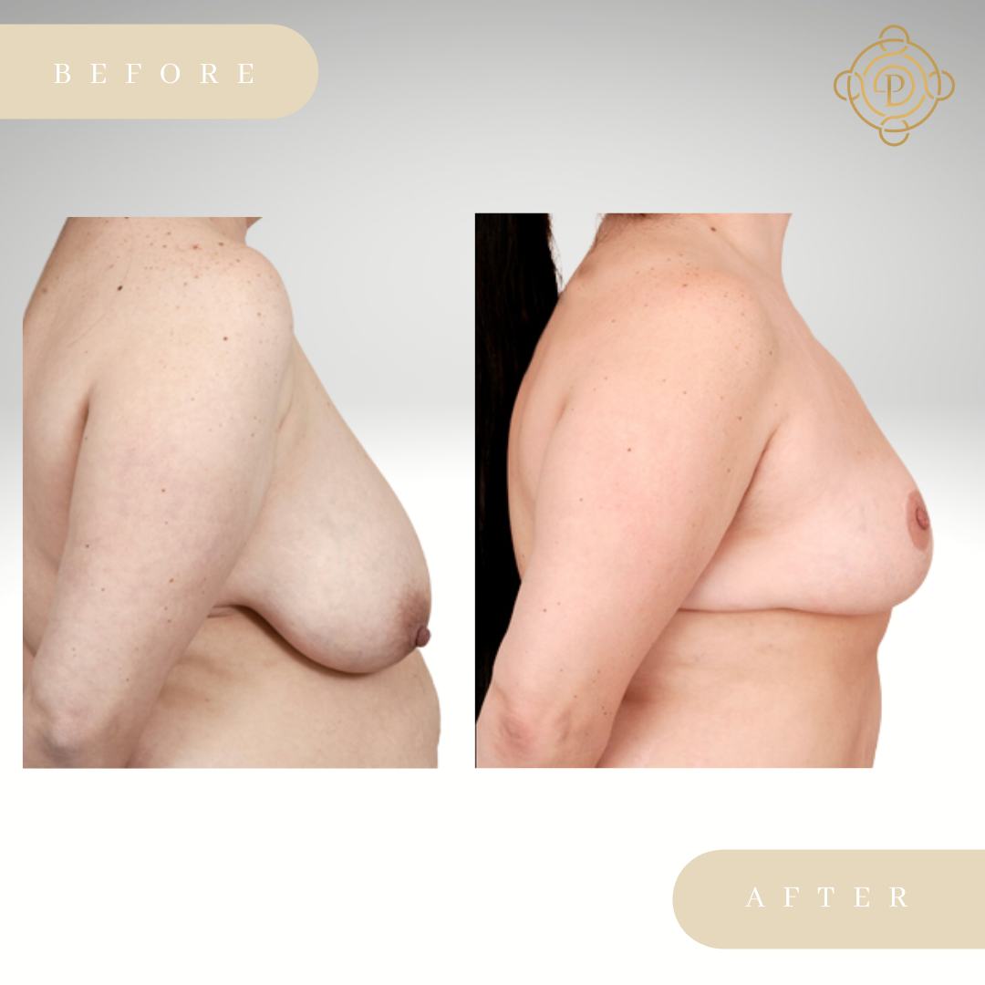 Side view of a female patient before and after breast lift.