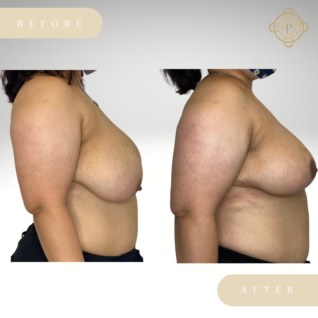 Side view of a female patient before and after breast reduction procedure.