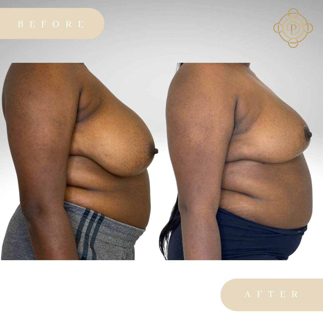 Side view of a female patient before and after breast reduction procedure.