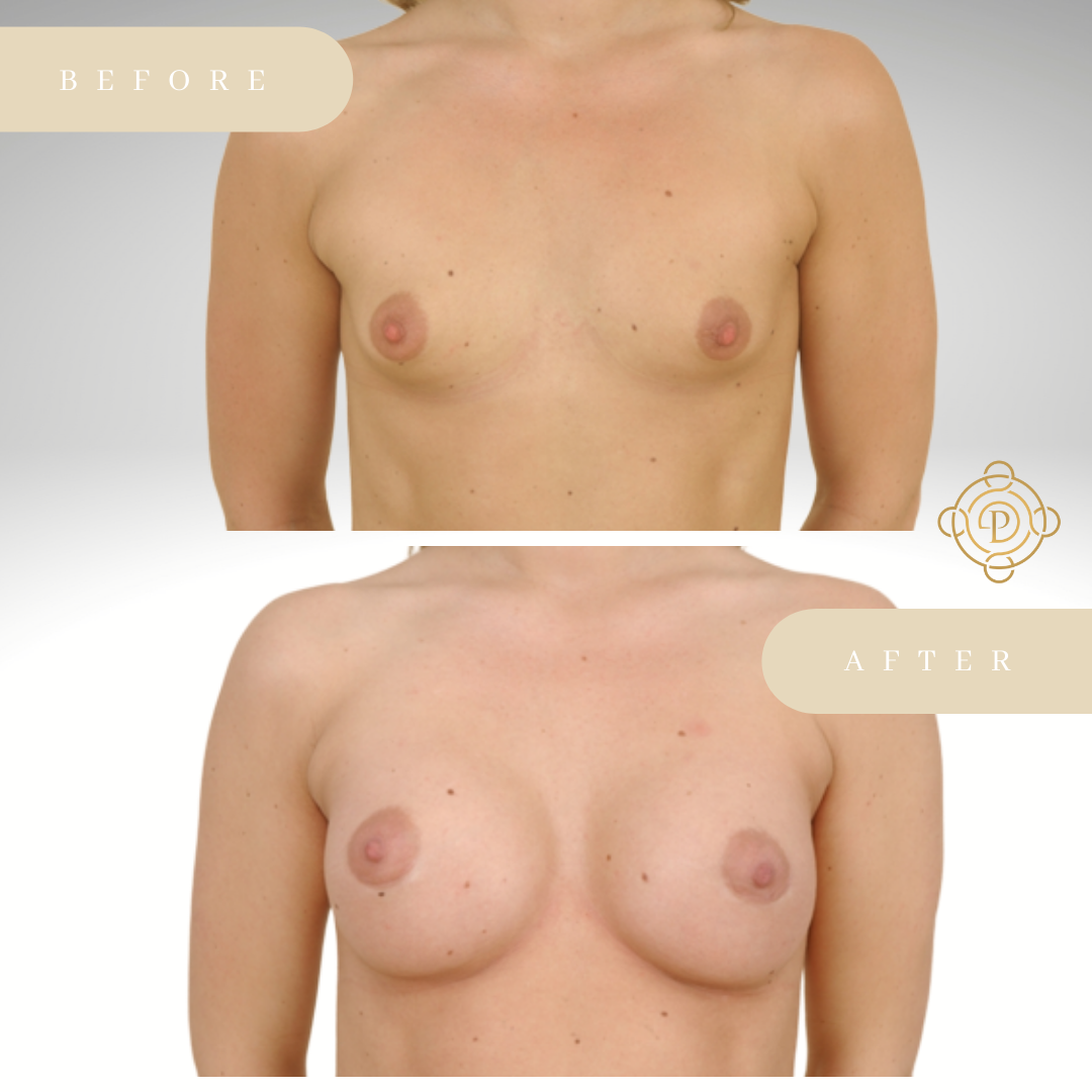 Female patient before and after tuberous breast correction surgery.