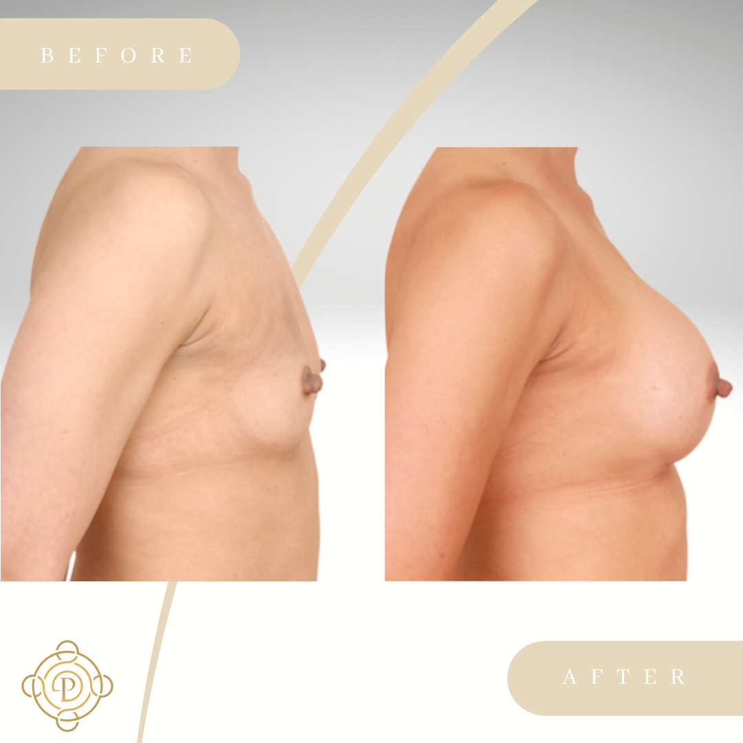 Side view of a female patient before and after breast augmentation procedure.
