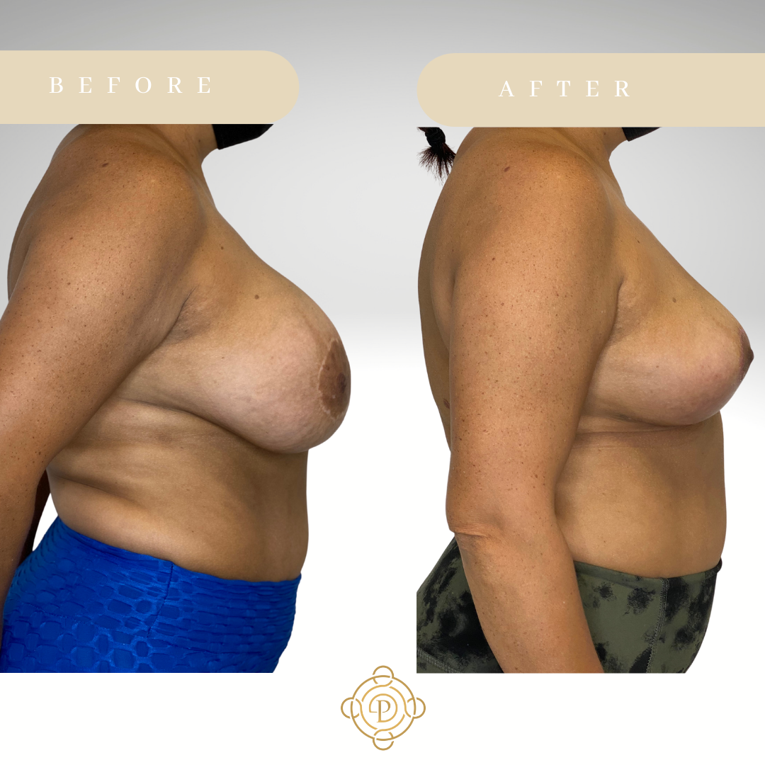 Side view of a female patient before and after breast implant removal procedure.