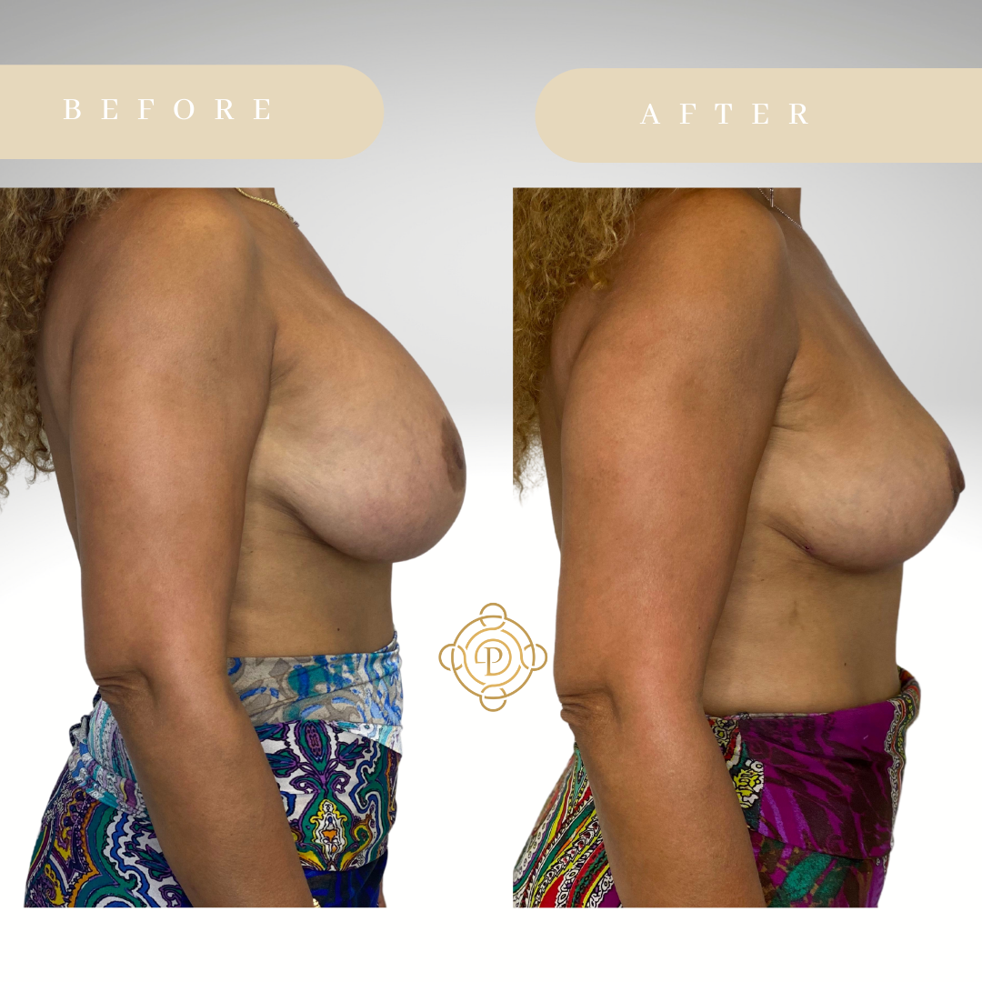 Side view of a female patient before and after breast implant removal procedure.
