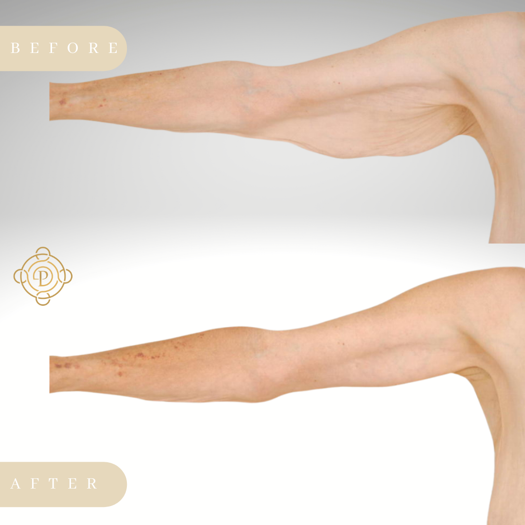 Patient's arm before and after brachioplasty.