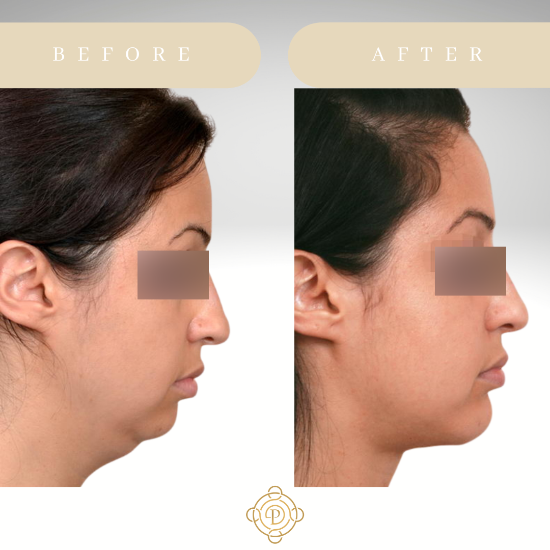 Female patient before and after neck liposuction and chin implant procedures.